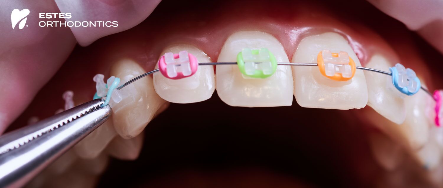 Physics Behind Orthodontic Rubber Bands - Estes Orthodontics Albany