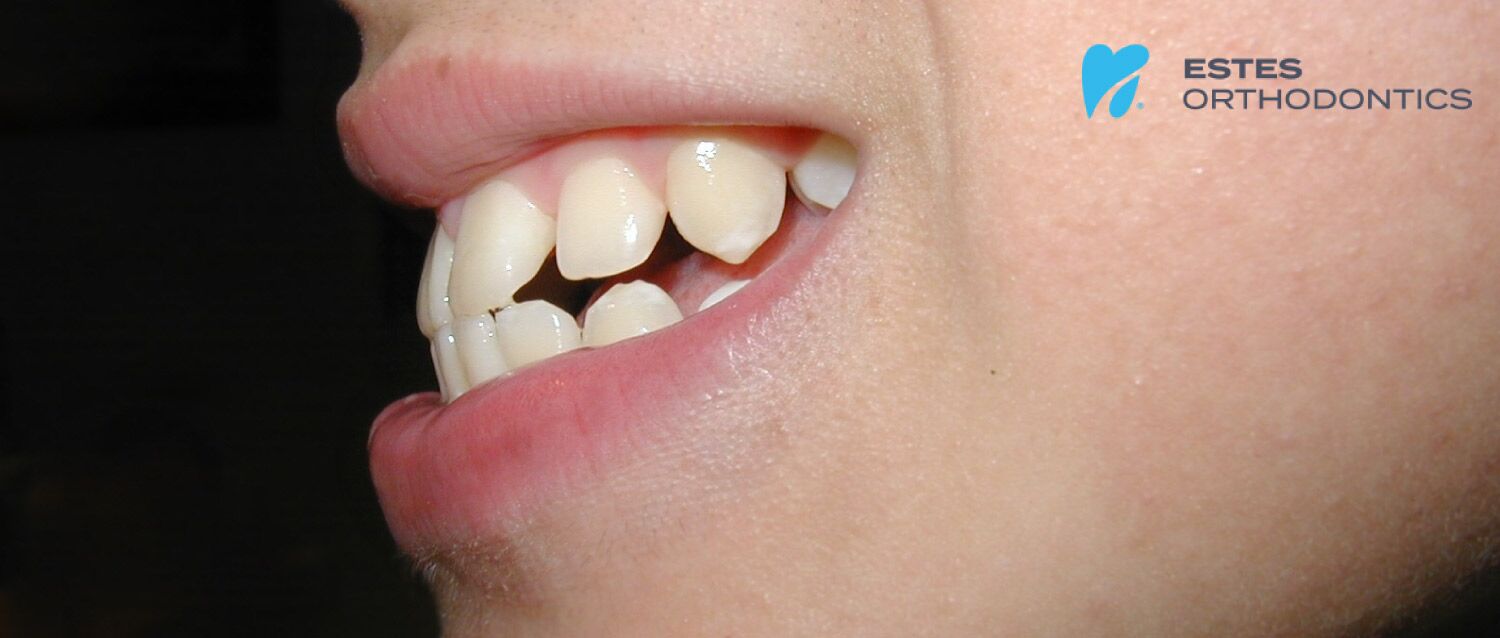 Overbites, Orthodontics